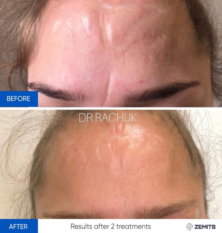 Zemits CarbonFrax Pro: CO2 Fractional Laser