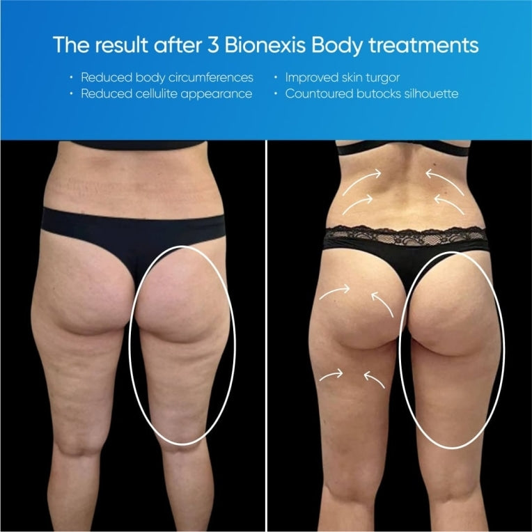 Zemits Bionexis Lite Pro Body Shaping System