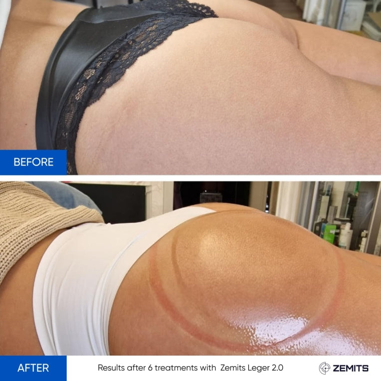 Zemits Leger 2.0 Vacuum Cupping System with XXL Cups in Set